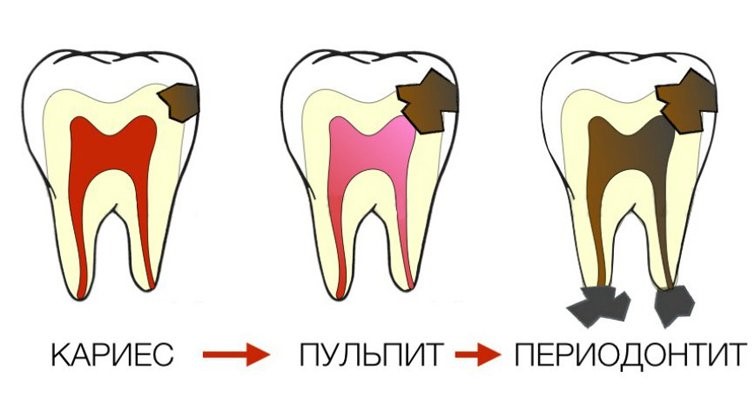 пародонтит