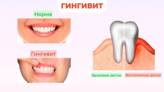 Катаральный в острой форме