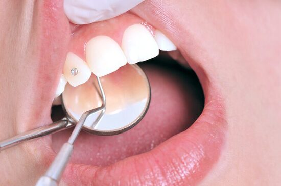 Как крепятся украшения для зубов