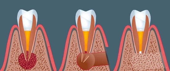 Цистэктомия зубов