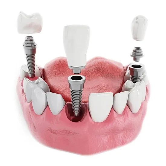 Этапы установки имплантации зубов