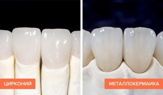 Как восстановить эстетический вид зубов с помощью циркониевых коронок?