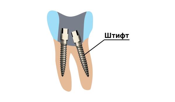 Когда нужно устанавливать штифт в зубе?