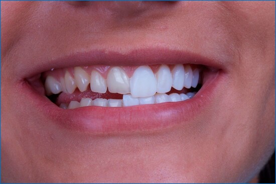 некрасивая форма зубных элементов