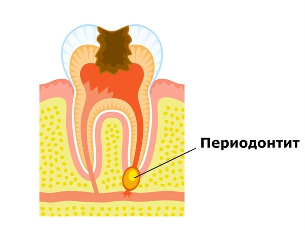 Пародонтит