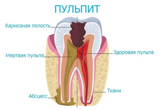 Как лечить пульпит без удаления зуба?