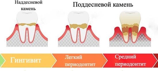 наддесневые