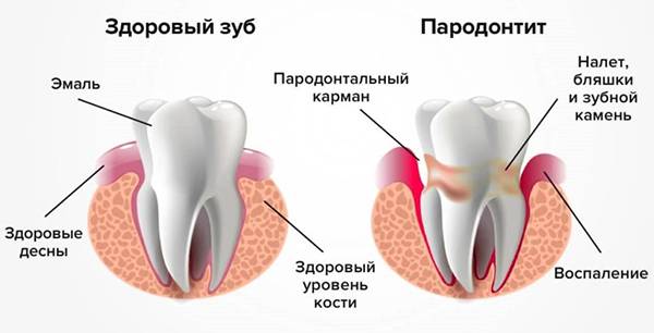 Почему разрушаются зубы у взрослых? Как укрепить зубы?