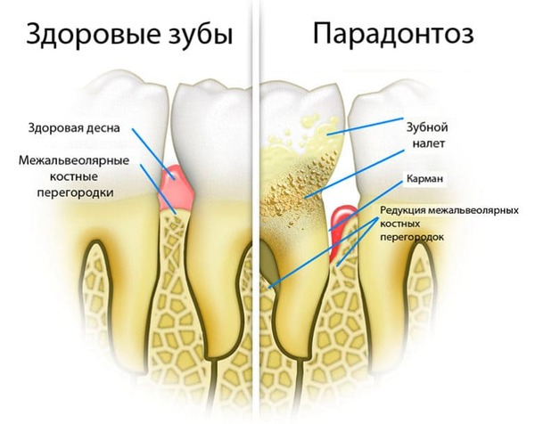 Пародонтоз