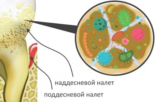 налет на зубах