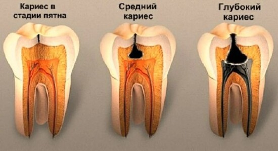 Лечение кариеса зубов