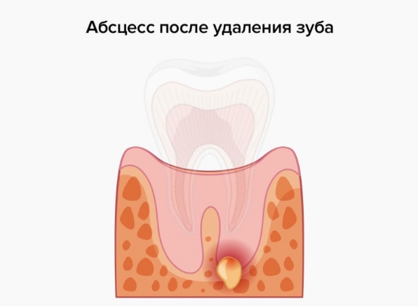 Может ли болеть зуб без нерва?