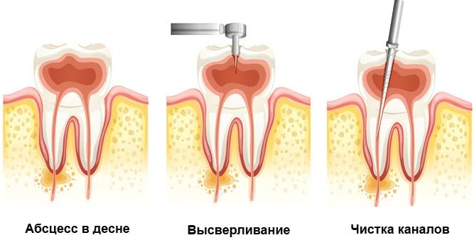 пломба