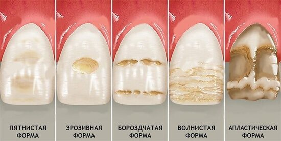 Почему со временем слабеет и портится зубная эмаль?
