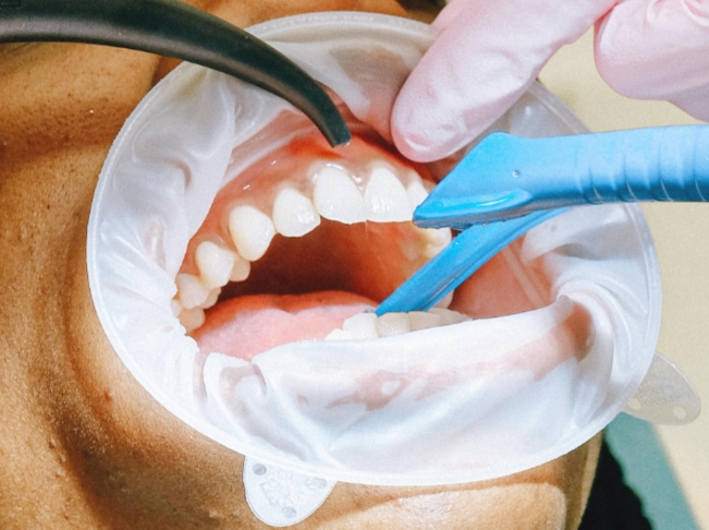 Чем опасен свищ на десне? Причины и лечение.