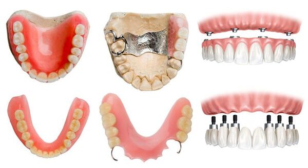 Современные материалы для зубных протезов