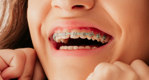 Можно ли исправить прикус брекетами?