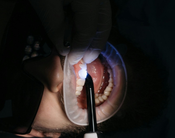 Что такое операция гингивэктомия?