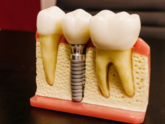 Этапы установки имплантации зубов: особенности Astra Tech.