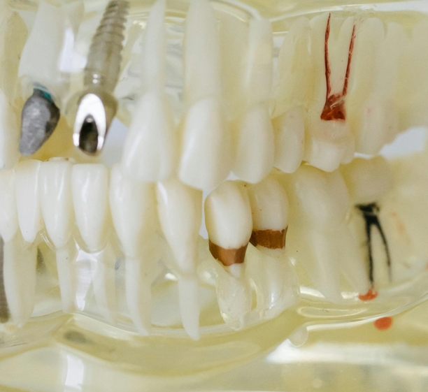 Что лучше — имплант или мост?