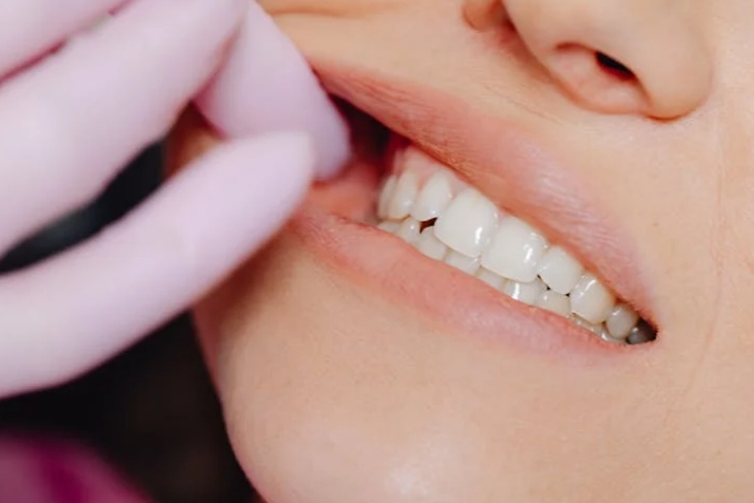 Почему появляется белый налет после удаления зуба?