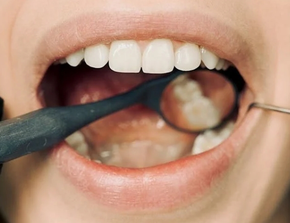 Что делать если выпала пломба из зуба?