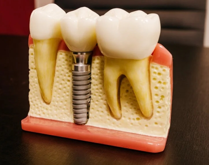 Что такое немедленная установка импланта?