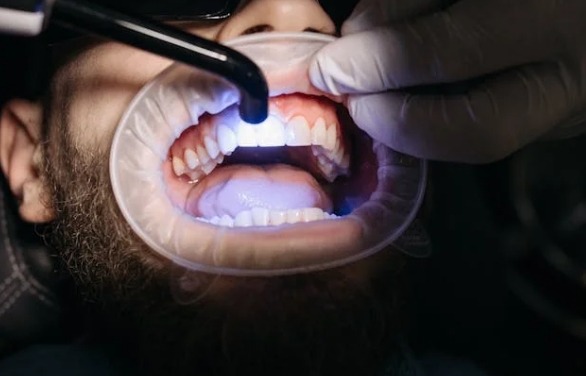 Лечение кариеса зубов у детей и взрослых