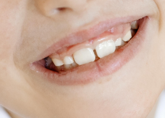 Почему скрипят зубы во сне? Симптомы и лечение.