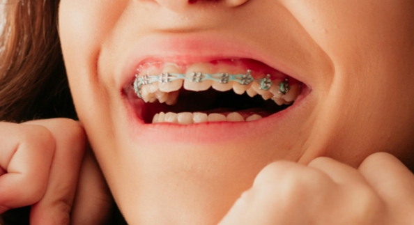 Можно ли установить брекеты на коронки?