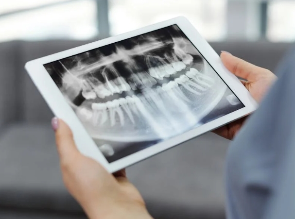 Почему выпадают импланты зубов и как этого избежать?