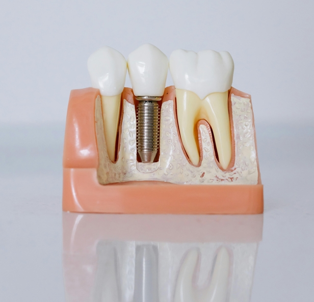 Имплантация зубов