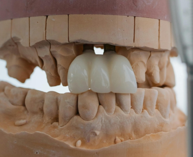 Сколько служат коронки и как за ними ухаживать?