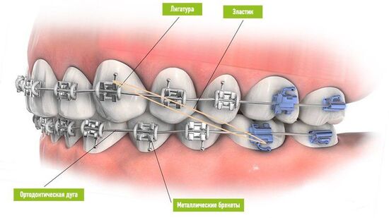 брекеты