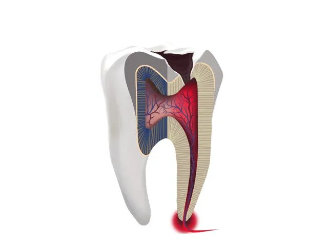 Эндодонтическое лечение трехканального зуба (в одно посещение)