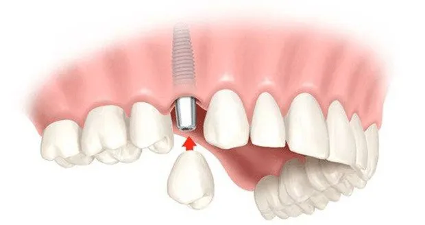 Коронка из диоксида циркония (prettau) на импланте системы Dentium Super Line купить в Москве фото