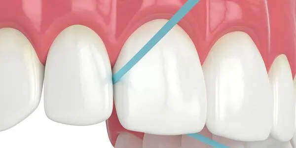 Наложение десневой повязки Septo-pack (до 5 зубов)